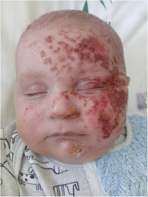Placa eritemato-edematosa con alguna costra adherente.