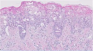 Unión dermoepidérmica con cambios vacuolizantes. En la dermis superficial hay edema y escaso infiltrado linfocitario perivascular.