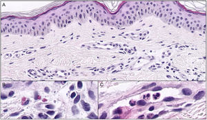 Histopatología de la pápula urticariforme. Aumento de la vascularización en dermis superficial (A, hematoxilina/eosina ×20). Eosinófilos (B, Hematoxilina/eosina ×60) y neutrófilos intravasculares (C, hematoxilina/eosina ×60).