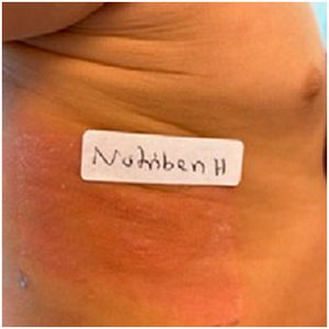 Prueba de parche positiva a las 48 y a las 72 h: positiva ++ a Nutribén® H.