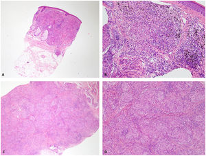 A y B) Biopsia de la ceja. Infiltración de la dermis por granulomas sarcoideos. Presencia de pigmento parduzco en el citoplasma de algunos histiocitos. C y D) Biopsia del dorso de la mano. Hipodermis ocupada por granulomas sarcoideos.