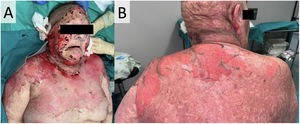 Example of a 53-year-old woman who presented to the dermatologic consultation with pembrolizumab-related toxic epidermal necrolysis against metastatic lung cancer. Exanthema was predominant over the face, neckline (panel A), and upper back region (panel B). In the following days. The patient