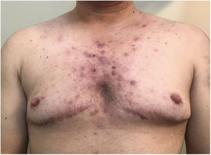 Acné inflamatorio en hombre trans. Comedones abiertos y cerrados, pápulas y nódulos inflamatorios en hombre trans en tratamiento con testosterona.
