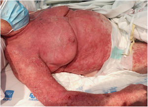 Afectación por psoriasis en forma de placas eritematodescamativas en tronco con algunas zonas mostrando despegamiento epidérmico.
