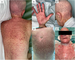 Clinical features. (a–c) Maculopapular rash with trunk, palmoplantar region, scalp, and retroauricular area involvement. (d) Positive Nikolsky