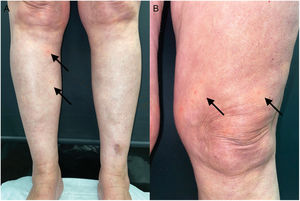 Appearance of bilateral hypochromic spots centered by an urticarial papule (black arrows) after 5minutes of standing (A and B).