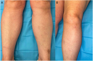 Resolution of the lesions 5minutes after sitting down again (A and B).