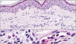 Histopathology of the urticarial papule. Increased vascularization in the superficial dermis (A, hematoxylin/eosin ×20). Eosinophils (B, hematoxylin/eosin ×60) and intravascular neutrophils (C, hematoxylin/eosin ×60).