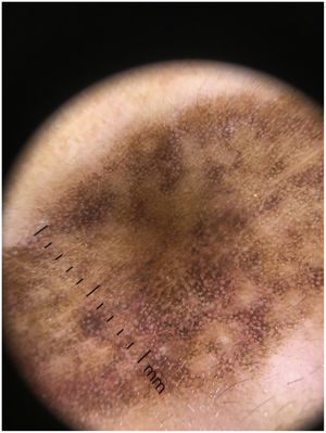 Exaggerated pseudoreticular network with light and darker brown dots in linear, peppering/nonspecific, reticular, and incomplete reticular arrangements. Fewer grayish globules seen as nonspecific and polygonal patterns. In some areas, blotch structures could be seen. Lastly, blue-gray annular granular structures could be seen in peri-eccrine areas.