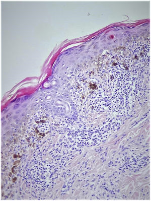 Cytoid body (arrow) in the epidermis, band-like lymphocytic infiltration (asterix) in the upper dermis, and intense pigment incontinence (×200 HE).