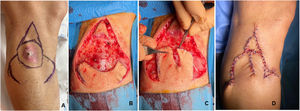 A) Diseño del colgajo obispo en un paciente con un carcinoma espinocelular en la pierna. B) Extirpación de la lesión junto a la incisión de los colgajos C) Desplazamiento lateral de los 2 colgajos de rotación en hacha. D) Se desplaza inicialmente el colgajo en isla y el defecto restante se cierra con los 2 colgajos en hacha laterales.