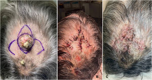 A) Diseño del colgajo obispo en un paciente con carcinoma espinocelular del cuero cabelludo. B) Desplazamiento inferior del colgajo en isla de pedículo subcutáneo y desplazamiento lateral de los 2 colgajos de rotación en hacha para conseguir el cierre del defecto quirúrgico. C) Retirada de puntos a los 12 días.