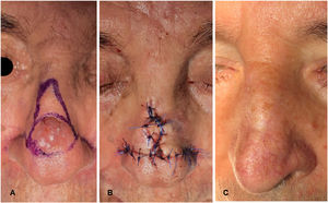 A) Diseño del colgajo obispo en un paciente con un carcinoma basocelular en el dorso nasal. B) Sutura final una vez realizada la movilización de los colgajos y recorte de los ángulos inferiores del colgajo en isla para que encajen y así facilitar el cierre perfecto. C) Resultado final a los 3 meses de la intervención.