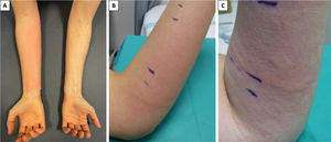 (A) Erythema on the stimulated forearm of a participant. (B) Linear edema and erythema affecting the skin of the forearm exposed to maximum vibratory stimulus in the area in contact with the edge of the vortex plate. (C) Linear edema and urticaria affecting another participant.