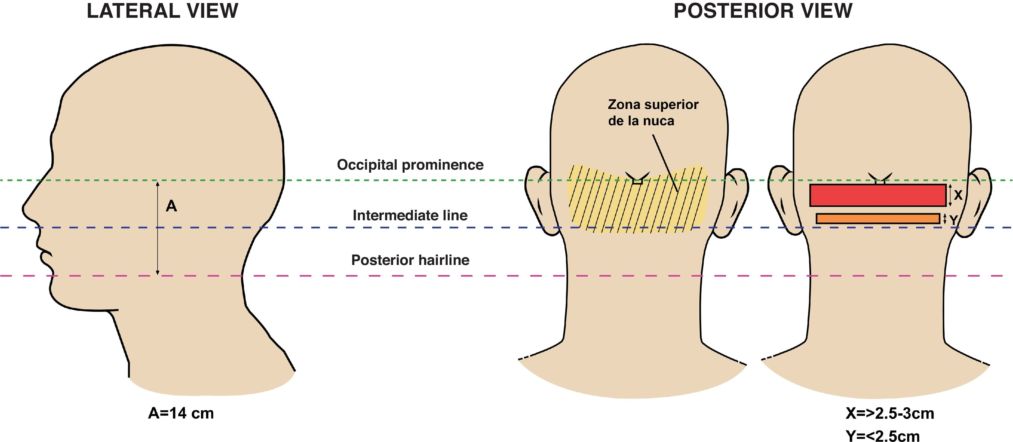 [Translated article] Acne Keloidalis Nuchae: A Therapeutic Challenge ...