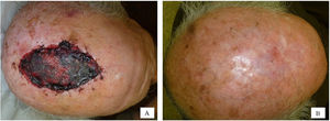 A) Imágenes preoperatorias del cuero cabelludo. B) Imágenes postoperatorias.