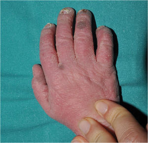 SAM syndrome (severe dermatitis, multiple allergies and metabolic wasting). Ichthyosiform erythroderma, onychodystrophy, and focal post-inflammatory hyperpigmentation on the dorsum of the hand and the fourth finger in a patient with a pathogenic variant in DSP.
