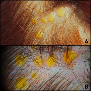 (A) Pápulas ovaladas, bien delimitadas, de coloración amarillenta, superficie lisa y de diámetro variable (4-6mm) en la región occipital del cuero cabelludo. (B) Por dermatoscopia se aprecian áreas amarillentas sin estructuras con algunos pequeños vasos ramificados en superficie y perilesionales.