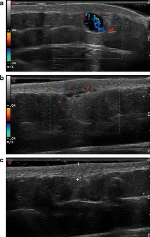 (a) Ultrasound corresponding to lesion #2, showing a hypoechoic, rounded lesion with well-demarcated borders, following a nodular pattern. Posterior enhancement and significant vascularization are also observed. (b) Ultrasound of lesion #4. In this case, a heteroechoic, polylobulated lesion with poorly defined borders, characteristic of the pseudonodular pattern, is seen. Vascularization is present but less profuse vs the previous case. (c) Ultrasound of lesion #10. This is an isoechoic, poorly defined lesion following a diffuse pattern.