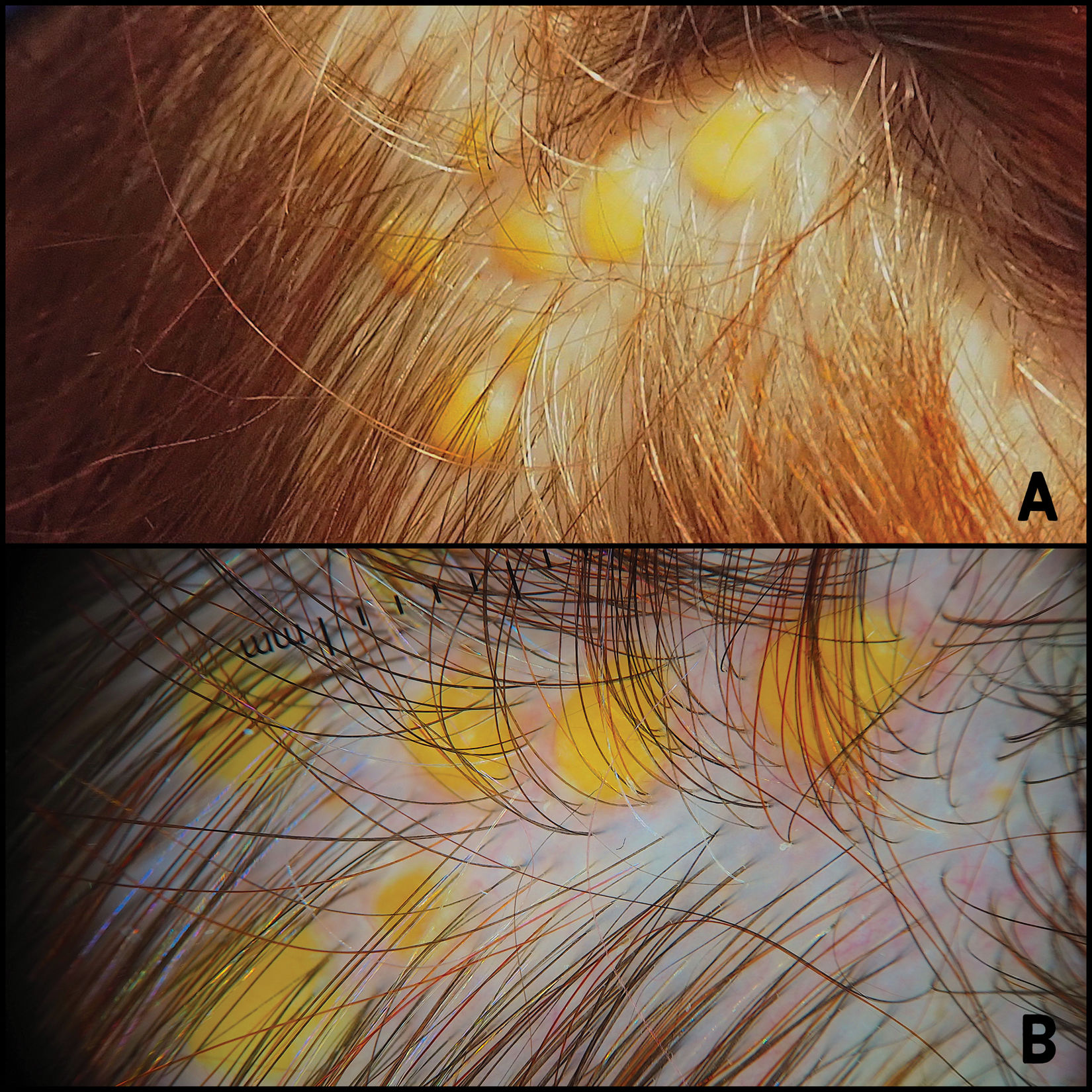Multiple Yellowish Papules on the Scalp | Actas Dermo-Sifiliográficas