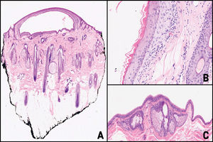 (A) Cystic cavity in the superficial dermis. Hematoxylin–eosin ×10. (B) Higher magnification showing the cyst wall composed of a stratified squamous epithelium, without a granular layer, internally lined by an eosinophilic cuticle with an undulating contour. Hematoxylin–eosin ×50. (C) Sebaceous glands adjacent to the cystic cavity. Hematoxylin–eosin ×40.