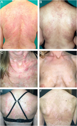 (A) Patient with SCLE lesions on the back. (B) After 16 weeks into anifrolumab treatment, the patient showed no active lesions, only residual poikiloderma. (C and D) Patient with SCLE lesions on her neck, chest, and back. (E and F) After 16 weeks into anifrolumab treatment, the patient maintained a complete response with post-inflammatory hypopigmentation.
