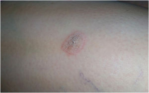 Two-year history exophytic, erythematous tumoral lesion with verrucous areas and a few hemorrhagic crusts, located on the dorsolateral aspect of the foot.