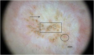 Polarized light dermoscopic images showing whitish structureless areas, bright white areas, follicular plugs, isolated dot-like and short linear vessels, and a peripheral erythematous area.
