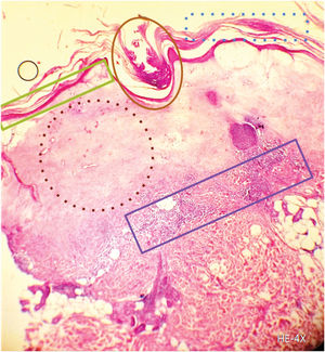 Hyperkeratosis (blue dotted line), epidermal atrophy (green square), orthokeratotic corneal plug (brown circle), collagen edema and homogenization (brown dotted line), and lymphocytic infiltrate (purple square) (hematoxylin–eosin [H–E], 4×).