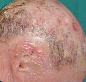 ARCI. Patient with harlequin ichthyosis due to a pathogenic variant in the ABCA12 gene presenting with severe auricle deformity and scarring alopecia on the scalp.