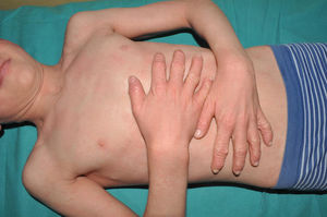 ARCI. Thickening of the skin on the back of the hands in a patient with self-improving ichthyosis due to a TGM1 variant. The trunk and the rest of the upper extremities appear almost normal.