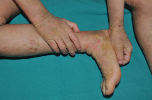 Epidermolytic keratinopathic ichthyosis due to a pathogenic variant in the KRT10 gene. Generalized involvement is observed with extensive areas of thickening in the upper and lower extremities and areas of skin fragility in the pretibial and lateral regions of the feet. The involvement stops at the palmoplantar border and spares the palms and soles.