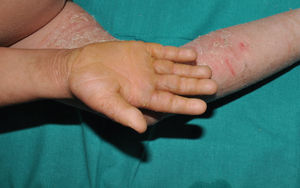 Epidermolytic keratinopathic ichthyosis due to a pathogenic variant in the KRT1 gene. Diffuse palmar thickening and involvement of the lower extremity are observed, with evident areas of cutaneous fragility.