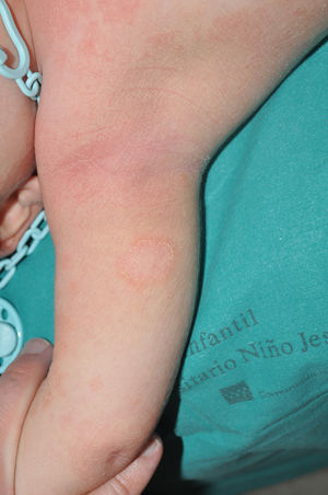 Annular epidermolytic keratinopathic ichthyosis due to a variant in the KRT10 gene. An annular lesion with superficial peripheral desquamation typical of certain KRT10 variants that result in this peculiar clinical form is observed.