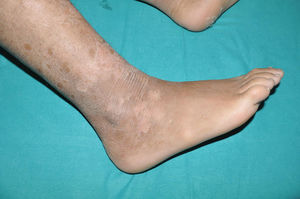 Superficial epidermolytic keratinopathic ichthyosis due to a KRT2 variant, where patchy superficial detachment of the epidermis (“flaking”) is observed.