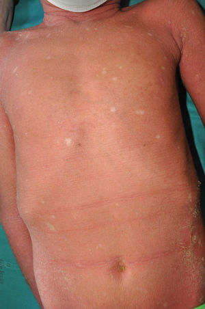 Non-epidermolytic keratinopathic ichthyosis with reverse mosaicism due to KRT10 variant. Note the lenticular lesions resembling normal skin on the anterior trunk.