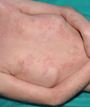 Skin exfoliation syndrome due to a pathogenetic variant in CDSN. The patient presents with diffuse erythema with patchy areas of superficial exfoliation.