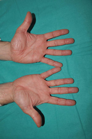 Ichthyosis vulgaris. Palmar hyperlinearity (filaggrin palms) in a patient with a pathogenic variant in FLG.