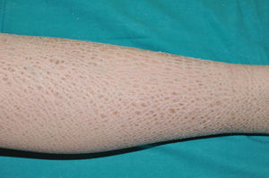 X-linked recessive ichthyosis. Typical dark polygonal scaling on the lower extremity.