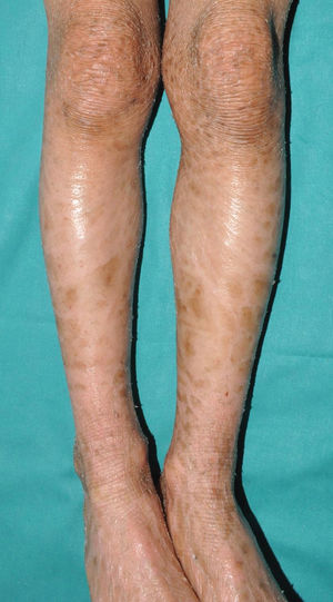 Autosomal recessive congenital ichthyosis. Lamellar desquamation in a patient with the dark phototype TGM1 variant.