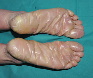 Autosomal recessive congenital ichthyosis. Plantar involvement in a patient with a TGM1 variant. The surface is thickened, smooth, shiny, and occasionally fissured.