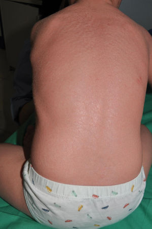 Autosomal recessive congenital ichthyosis. Fine scaling and moderate erythroderma are observed in a patient with an ABCA12 variant, demonstrating the phenotypic variability of this genetic variant.