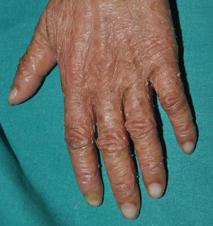 Autosomal recessive congenital ichthyosis. Patient with a pathogenic variant in TGM1. Pseudoleukonychia. Note how the loss of elasticity of the skin of the hands causes the nail bed to become vascularized when the patient attempts to stretch his fingers.