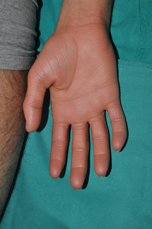 ARCI. Palmar involvement in a patient with a variant in the ALOX12B gene. Note the thickened, shiny, and scaly appearance of the palm without the yellowish hue seen in other palmar keratodermas.