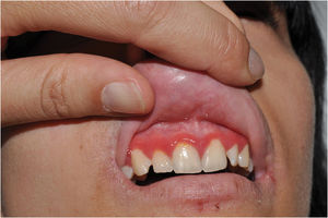 Hereditary mucoepithelial dysplasia due to a pathogenic variant in SREBF1. Typical gingival erythema of the disease.