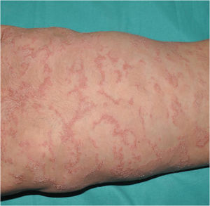 Netherton syndrome. Poly-lobulated arcuate lesions with a double scaly border, characteristic of ichthyosis linearis circumflexa, in a patient with a pathogenic variant in the SPINK5 gene.