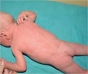 SAM syndrome (severe dermatitis, multiple allergies and metabolic wasting). Severe ichthyosiform erythroderma and scalp hypotrichosis in a patient with a pathogenic variant in DSG1. Note the blood on the nails caused by scratching due to intense itching.