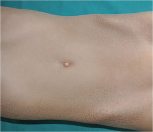 Trichothiodystrophy. Brown lamellar-like scaling on the trunk of a patient with a pathogenic variant in MPLKIP.