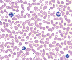 Chanarin–Dorfman syndrome. Peripheral blood smear of a patient with a pathogenic variant in ABHD5, showing lipid droplets in the cytoplasm of granulocytes (Jordan anomaly).