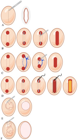 Schematic representation of surgical options for hidradenitis suppurativa. (A) Surgical incision and drainage, (B) Deroofing, (C) Seton placement, (D) Skin-tissue-sparing excision with electrosurgical peeling, (E) Lesional excision, (F) Regional excision.